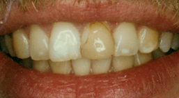 Rekonstrukcija gornjih prednjih zubi
